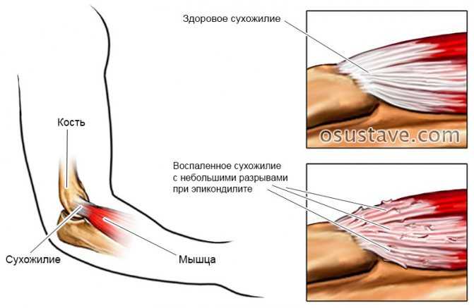 Вывих: первая помощь. что надо делать и чего нельзя делать при вывихе