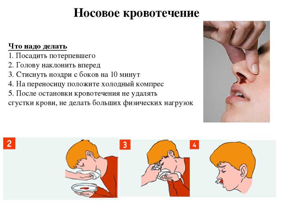 Остановить носовое кровотечение в домашних. Остановить кровотечение из носа. При кровотечении из носа. Остановка кровотечения из носа. Как остоновитькрофь из носа.