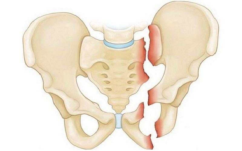 Переломы костей таза: классификация, клиника, диагностика, лечение