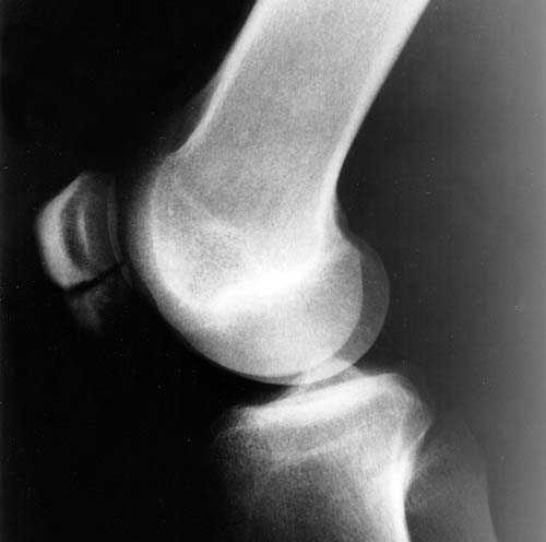 Нестабильность коленного сустава