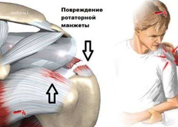 Плечевой сустав: артроскопия