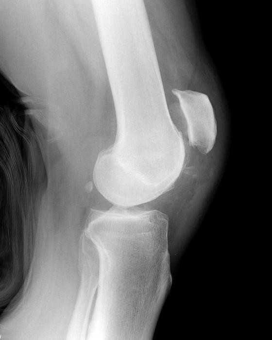 Виды переломов колена, причины и симптоматика Первая помощь: что нужно сделать сразу Куда обращаться, как лечить, правила реабилитации