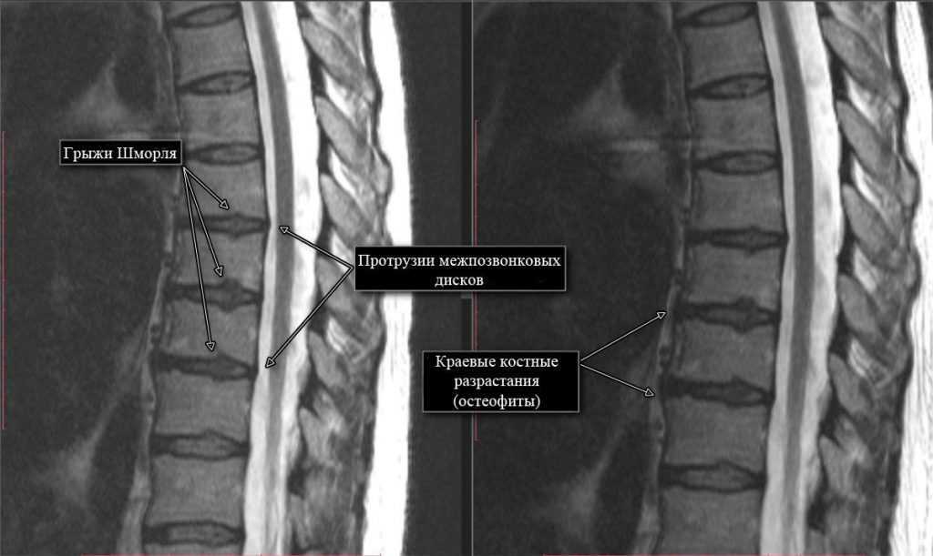 Боль в спине: причины, лечение, ортезирование | medi