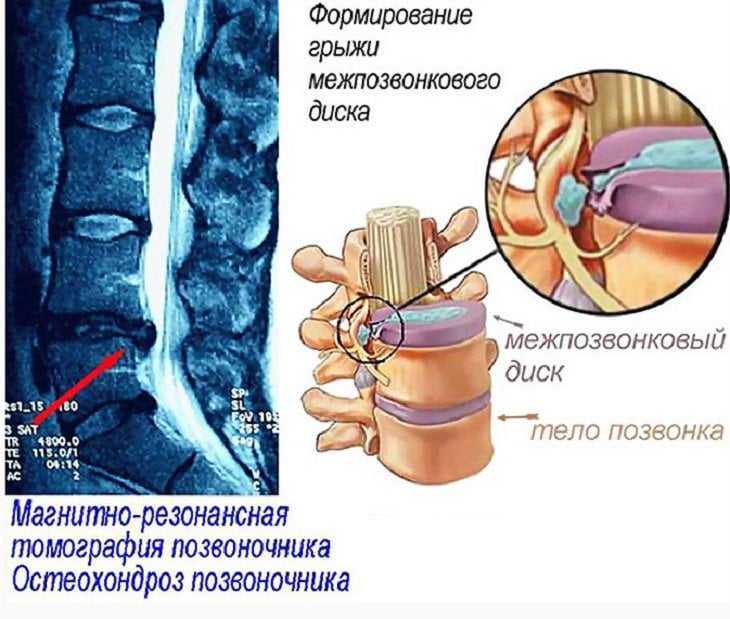 Блокады при болях в позвоночнике: эффективное лечение боли в спине