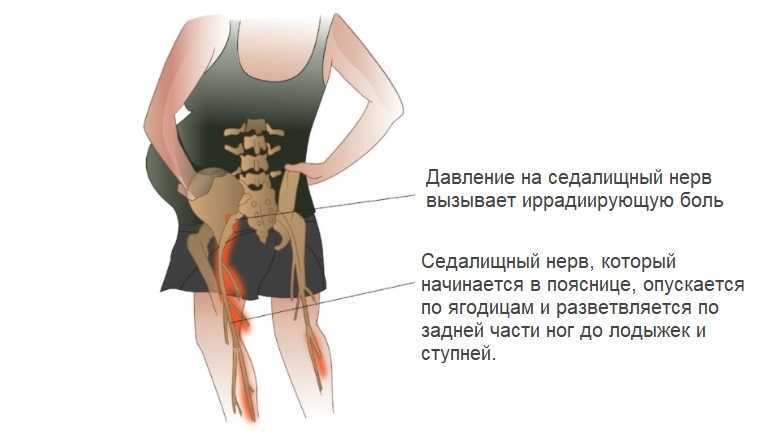Лечение растяжения мышц спины