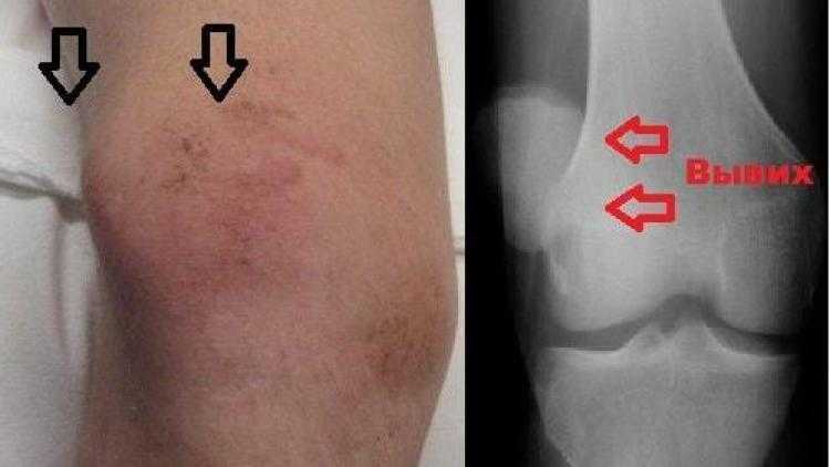 Гонартроз коленного сустава ️: симптомы, причины, диагностика и лечение