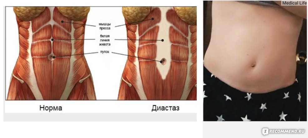 Сильные мышцы живота. Диастаз брюшной полости. Диастаз прямой мышцы живота.