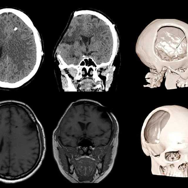 Черепно мозговая травма картинки