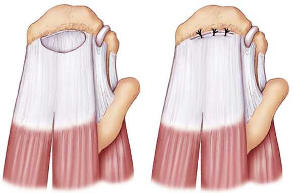 Артроз плечевого сустава