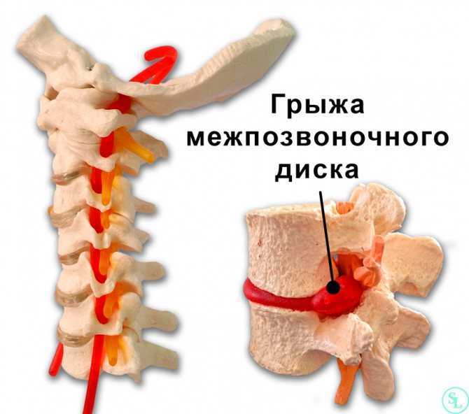 Лечение болей в спине у спортсменов
