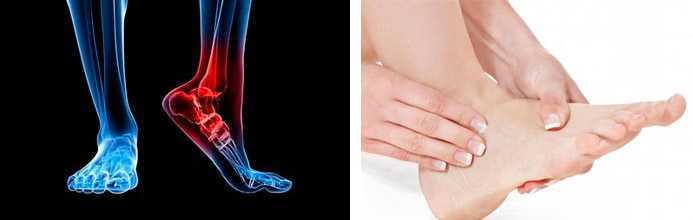 Почему могут болеть колени после и во время бега Что делать и как бороться с болью суставов коленей при беге или после него