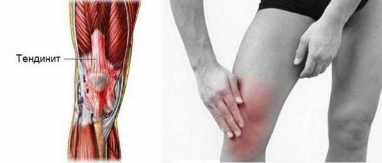 Опухло колено: выясняем причину с помощью ультразвуковой диагностики (узи)