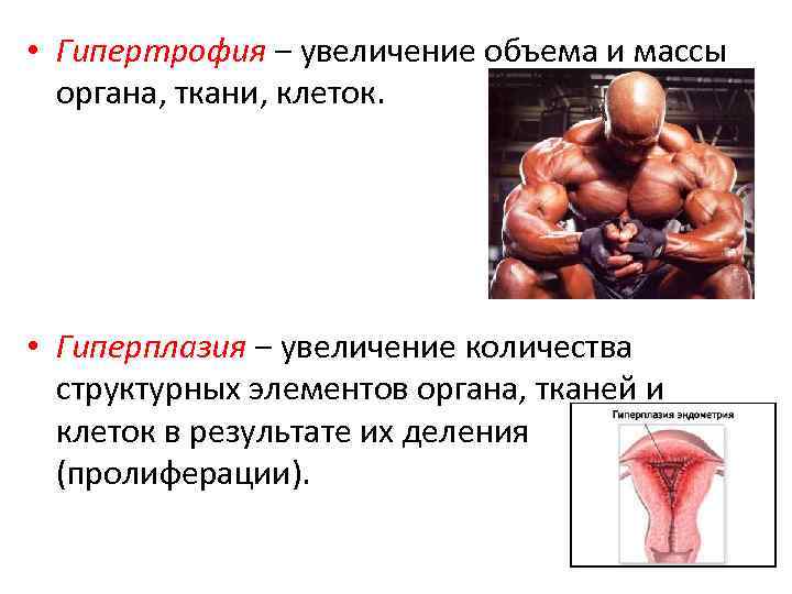 Гиперплазия мышц