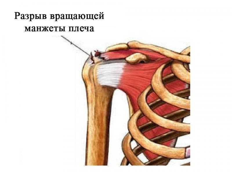 Травмы плеча: виды, профилактика и лечение Посттравматическое восстановление Строение плечевого сустава Рекомендации по тренировкам