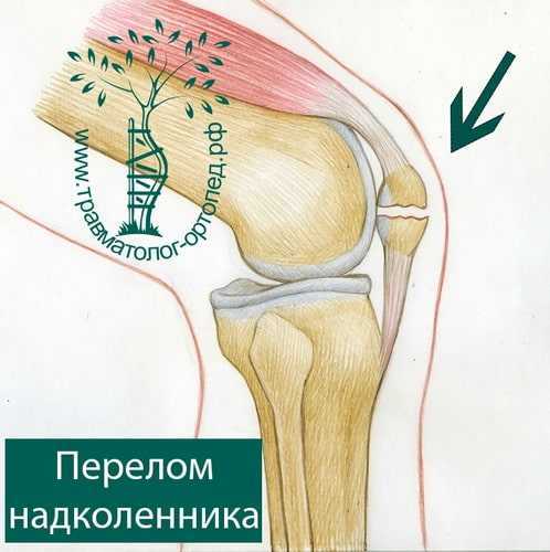 Перелом костей, симптомы и диагностика перелома. лечение перелома костей.