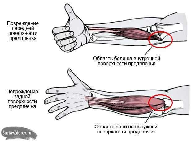 Ушиб или перелом: как отличить? – напоправку