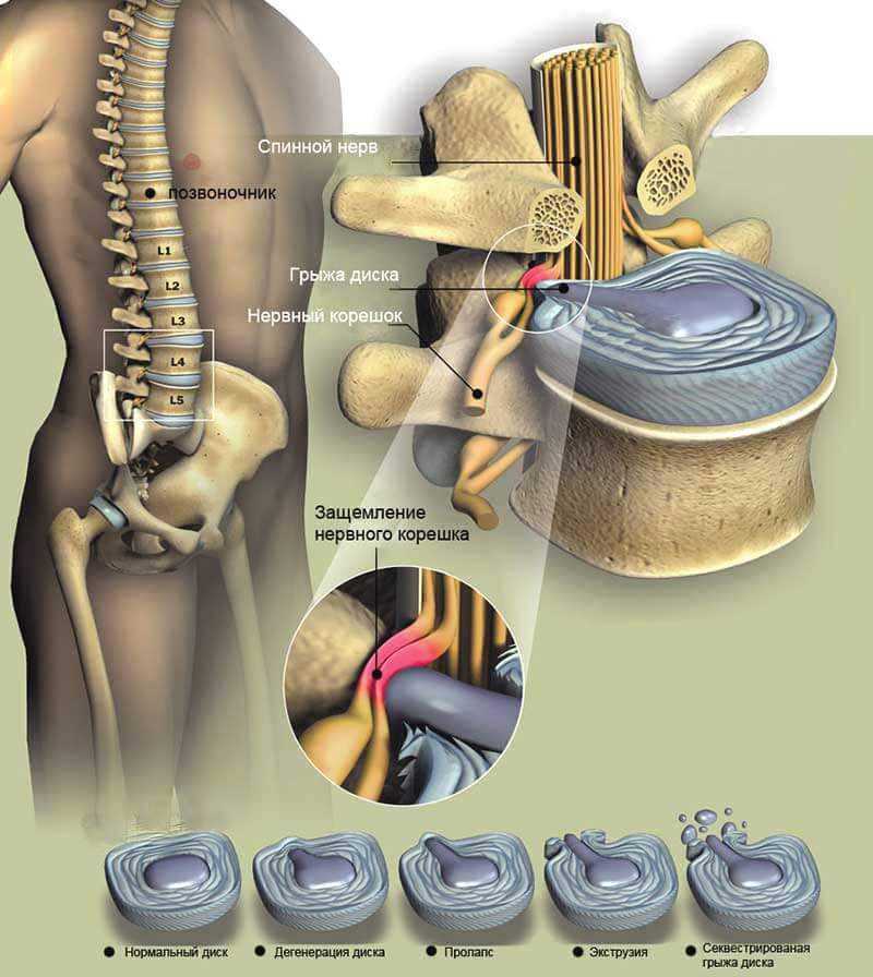 Шейный остеохондроз ️: симптомы, признаки и лечение остеохондроза шейного отдела