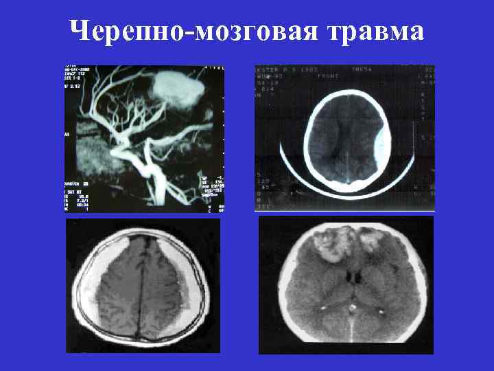 Травматических повреждений мозга