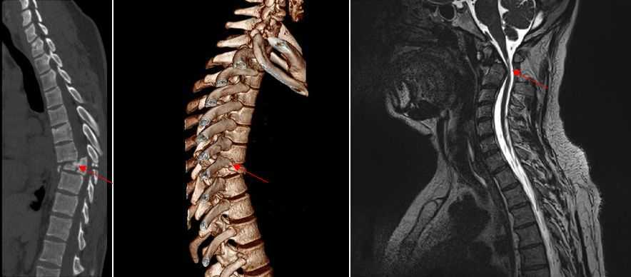 Травма позвоночника спинного мозга перелом позвоночника спины шеи, травма ныряльщика позвоночника спины шеи, спинальная травма