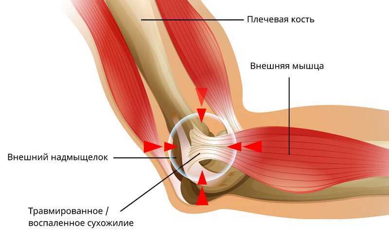 Как избавиться от боли в локтевом суставе - нолтрекс.