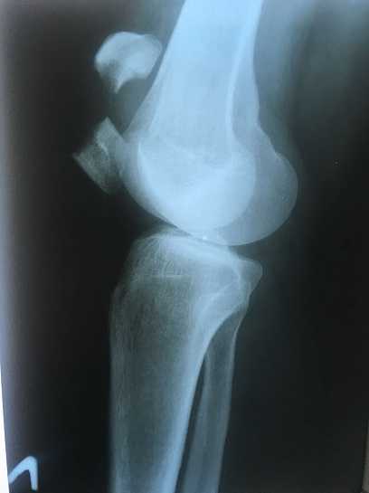 Перелом коленной чашечки. лечение травмы коленной чашечки