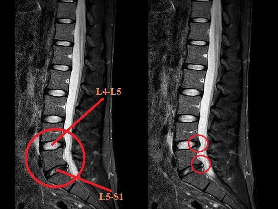 Грыжи дисков l4 s1 в поясничном отделе фото